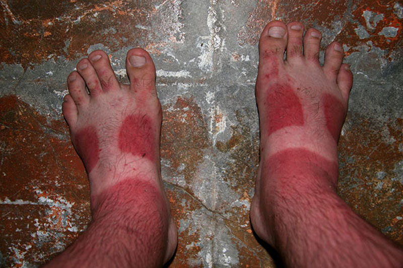 sunburned-feet
